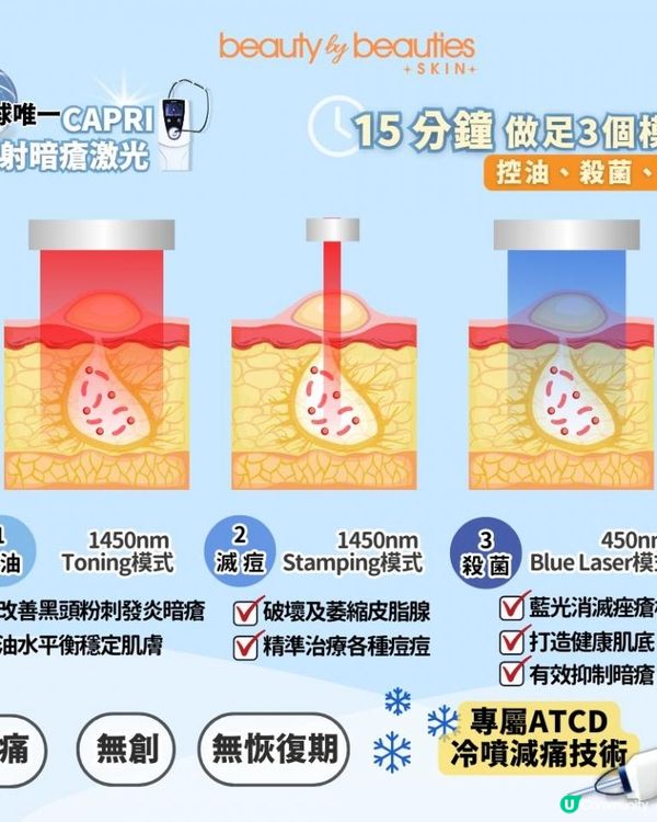詳細拆解暗瘡成因，暗瘡斷尾治療!全球唯一CAPRI藍雷射暗瘡激光