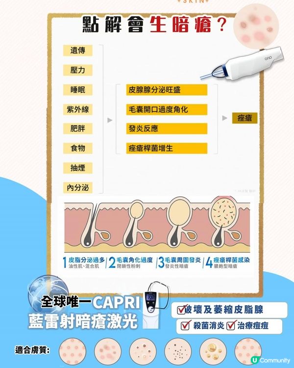詳細拆解暗瘡成因，暗瘡斷尾治療!全球唯一CAPRI藍雷射暗瘡激光