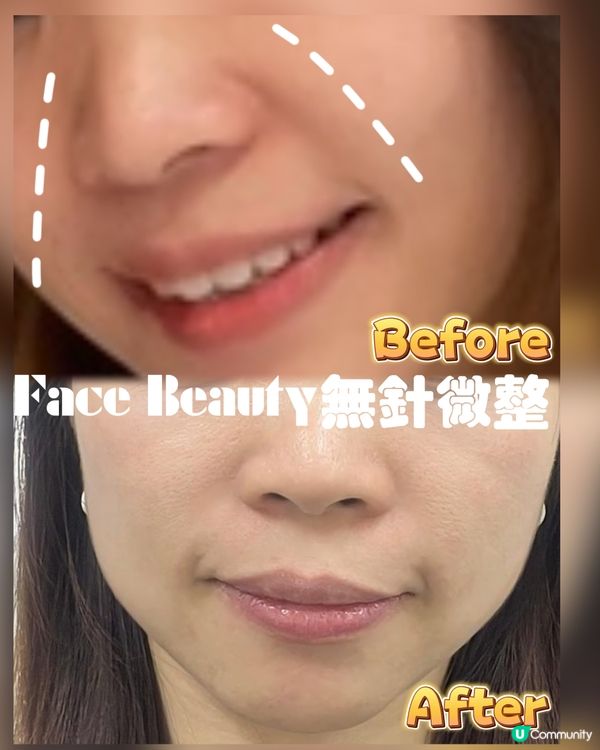 超有效安全性高去除皺紋無針微整