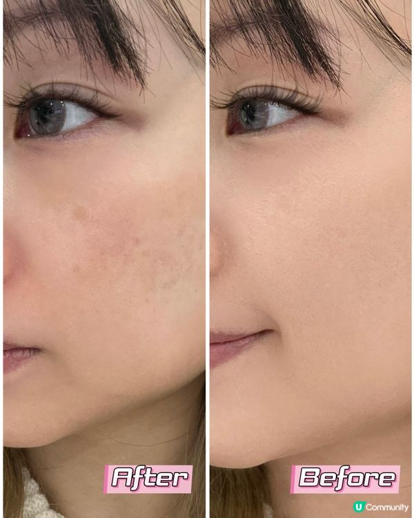 冬天都唔怕曬黑？ ☀️ 希納露美白丸幫你白返！✨