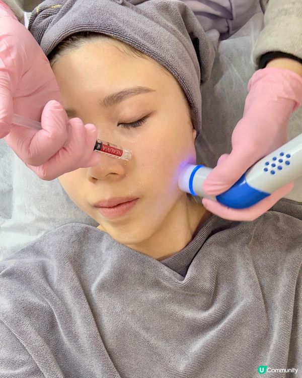 日本凍到爆🥶  返港即做冰冰針❄️  救番乾到甩皮嘅肌膚！