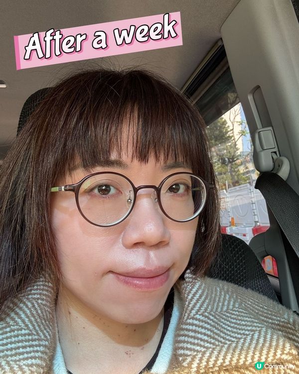 疣不單止影響外觀，仲會傳染俾身邊嘅人🥲分享吓脫疣經歷～😗