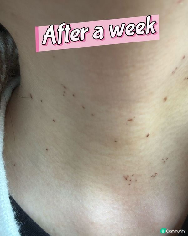 疣不單止影響外觀，仲會傳染俾身邊嘅人🥲分享吓脫疣經歷～😗