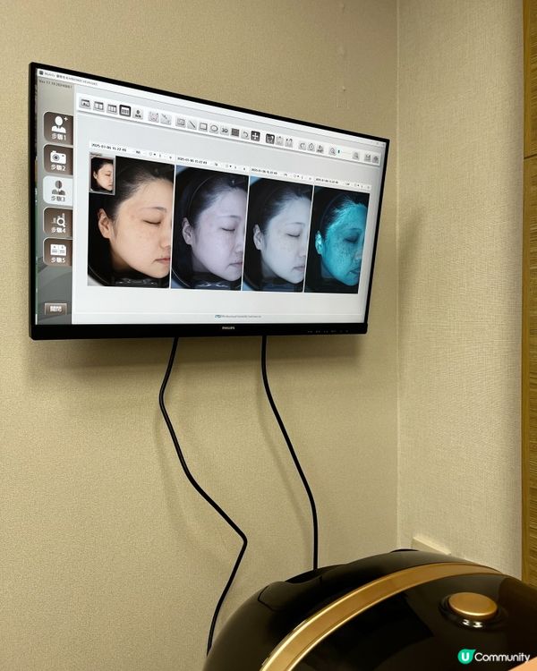 專業去疣之旅～