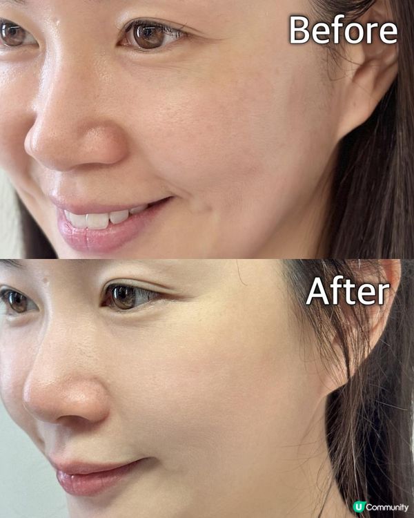 皮膚角質層過厚，阻住護膚品吸收😮