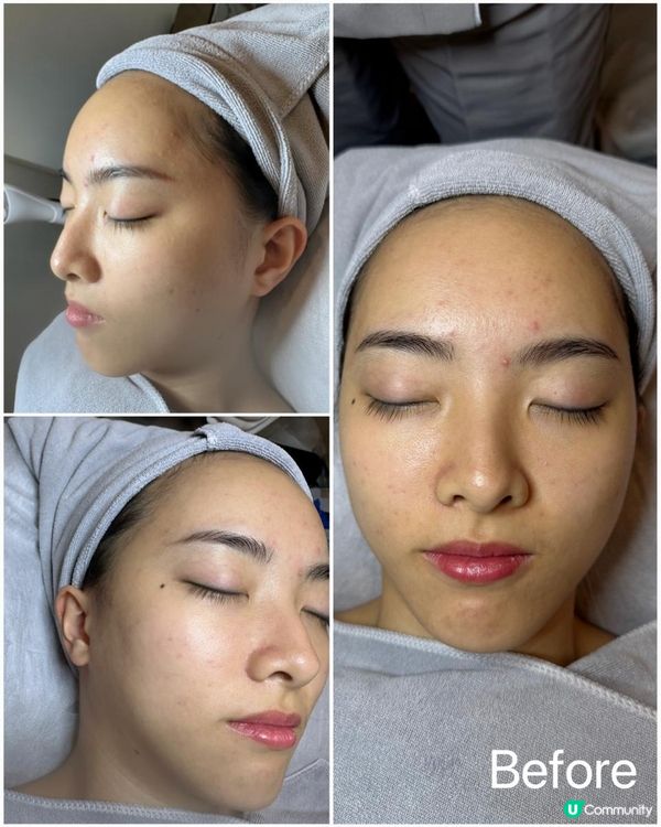 UBG暗瘡從本清療程