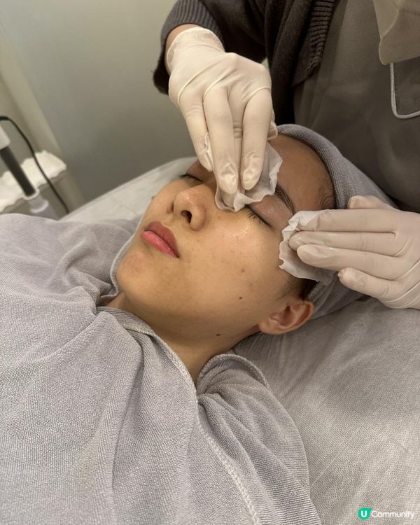 UBG暗瘡從本清療程