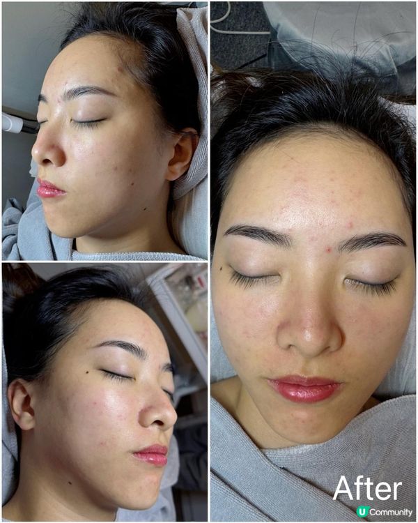 UBG暗瘡從本清療程