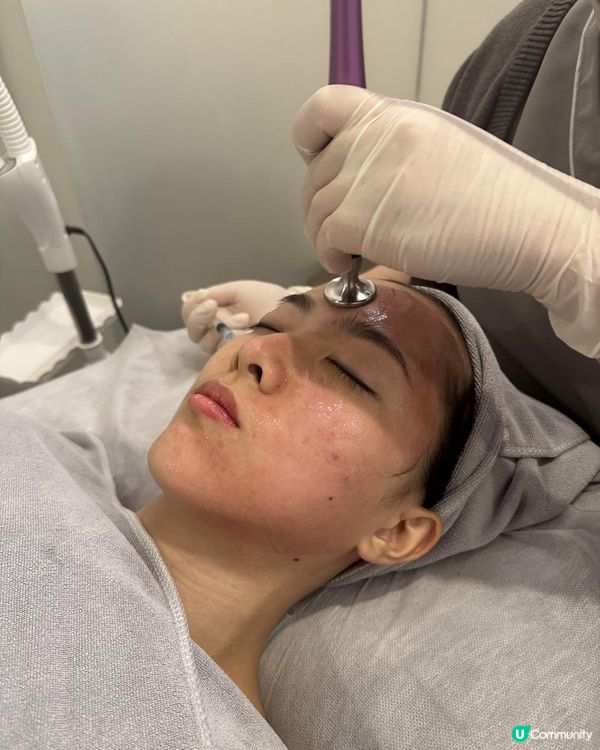 UBG暗瘡從本清療程