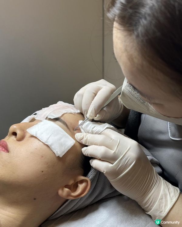 UBG暗瘡從本清療程