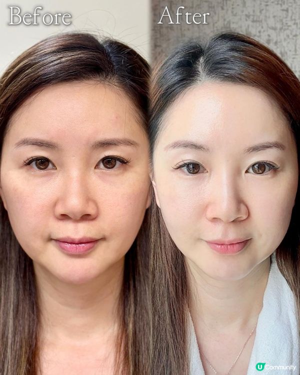 ✨想keep住青春美肌？醫美效果+NMN係黃金搭配！💎