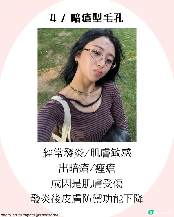 4大改善毛孔方法+毛孔粗大成因！了解毛孔類型才能對症下藥✨ 護膚好物推薦！