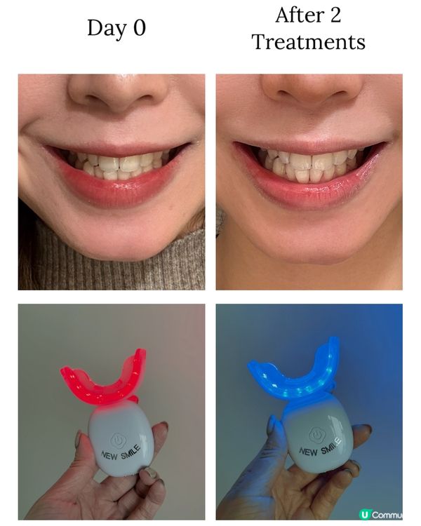 限時團購New Smile LED 第五代納米護牙美白套裝 
