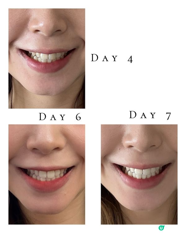 限時團購New Smile LED 第五代納米護牙美白套裝 