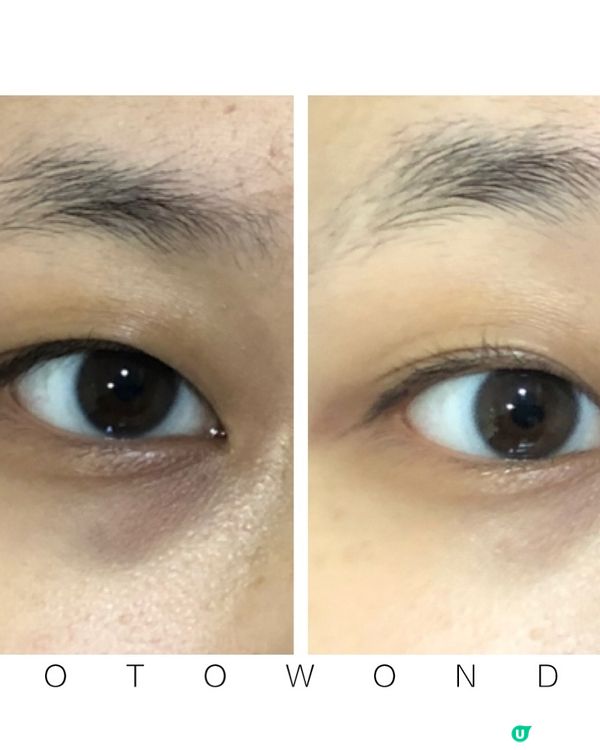 《試後感》Eye Glow皇牌淚溝療程好唔好？效果如何？