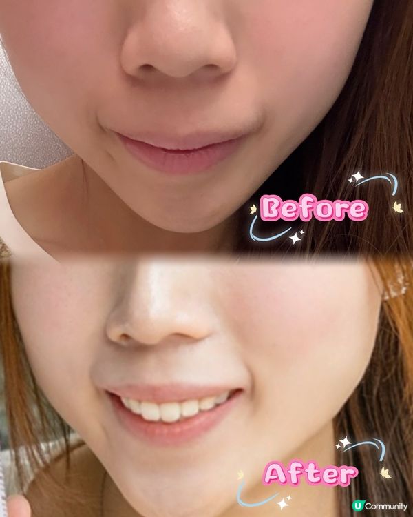 白色情人節約會✨  小熊煙酰胺美白軟糖幫你閃爆全場！