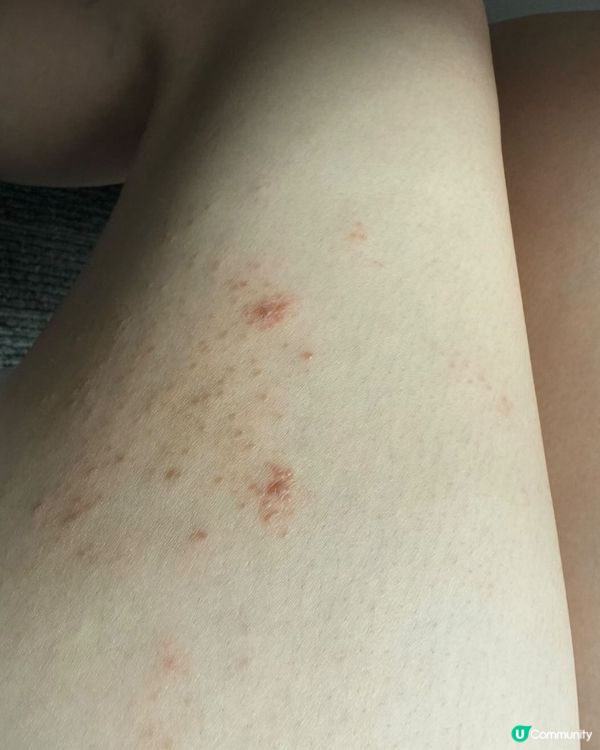 唔係下下要靠類固醇藥膏🥹非廣告真心推薦的止痕藥膏