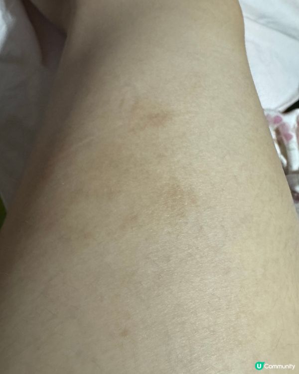 唔係下下要靠類固醇藥膏🥹非廣告真心推薦的止痕藥膏