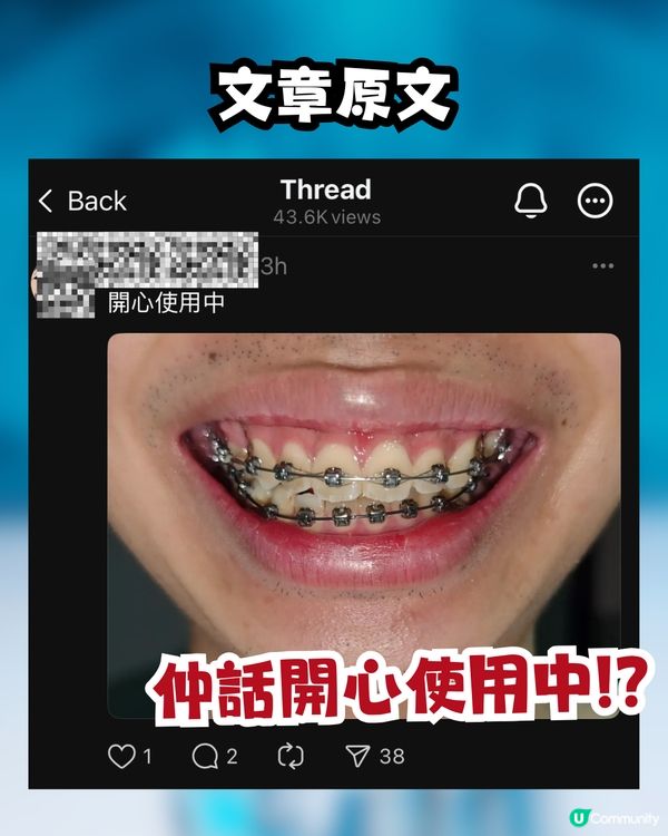 網民買入淘寶箍牙套裝😳⁉️實行自己箍牙:開心使用中🦷
