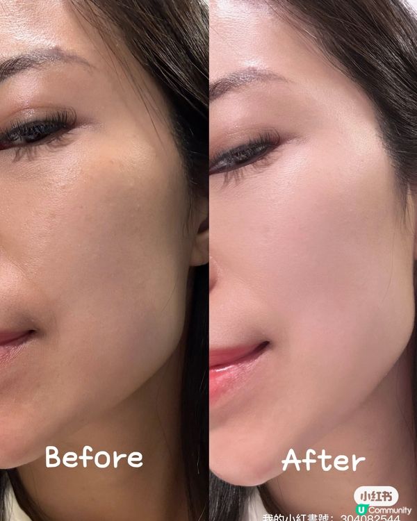 生完BB都唔怕老👵🏻  無針埋線啫喱救我命💪🏻