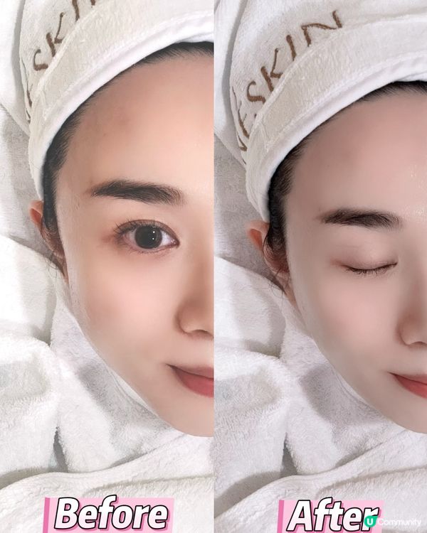 黑金鋼療程✨  包包面拜拜👋