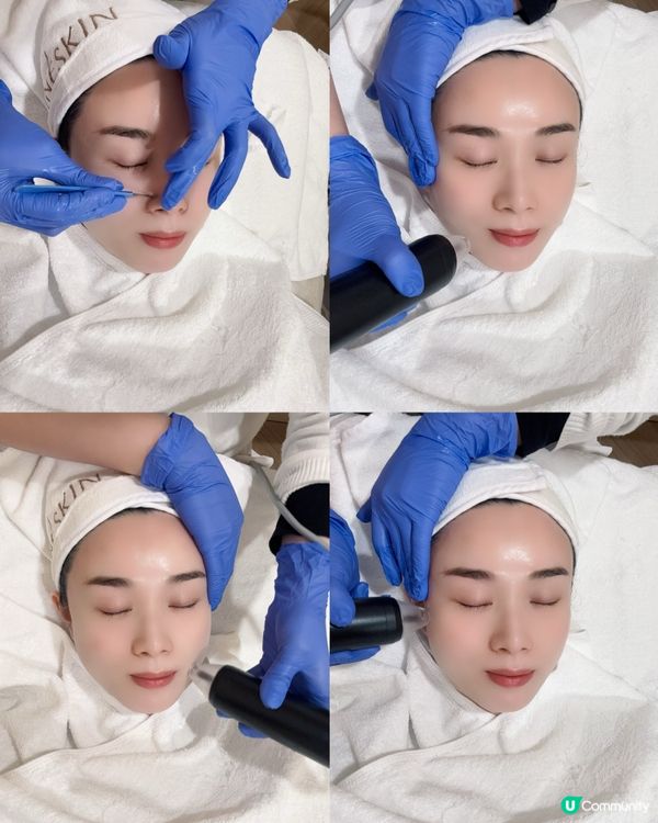 黑金鋼療程✨  包包面拜拜👋