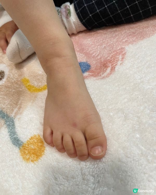 天氣咁反覆，皮膚又痕又腫 😭😭😭