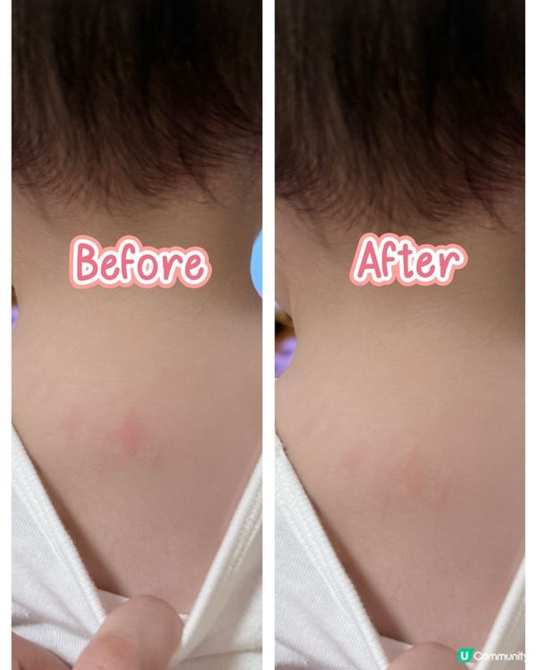 夏日止痕救星🍊