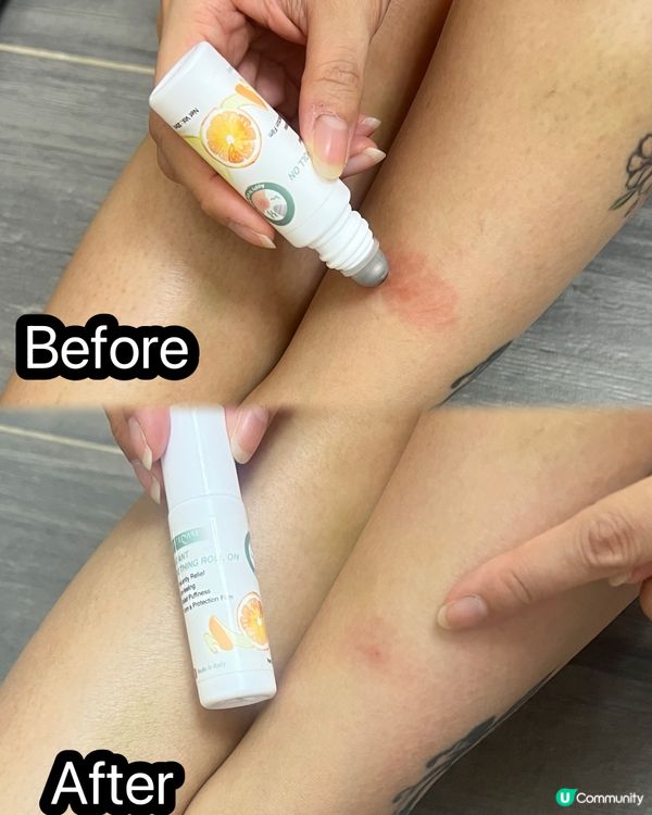 蚊咬腫到爆💥  點算好？😭  #尚護健甜橙即效止痕舒敏走珠