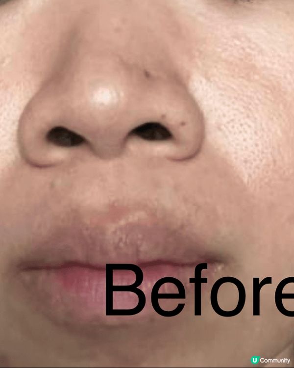 新年前諗住靚樣見人，去咗打第一次嘅黃金微針，打完治療師都提我...