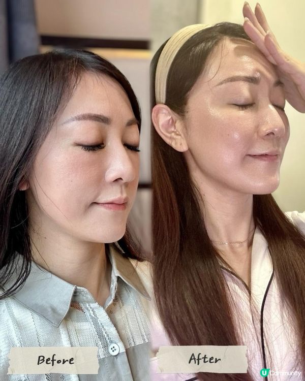 🌟1分鐘即時拉提！韓式無痛填充術✨