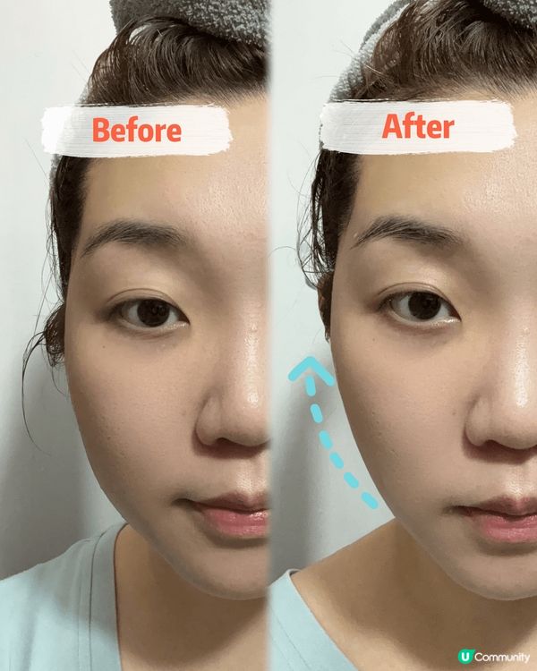 INFYNYTI HIFU 小顏拉提緊致凍膜