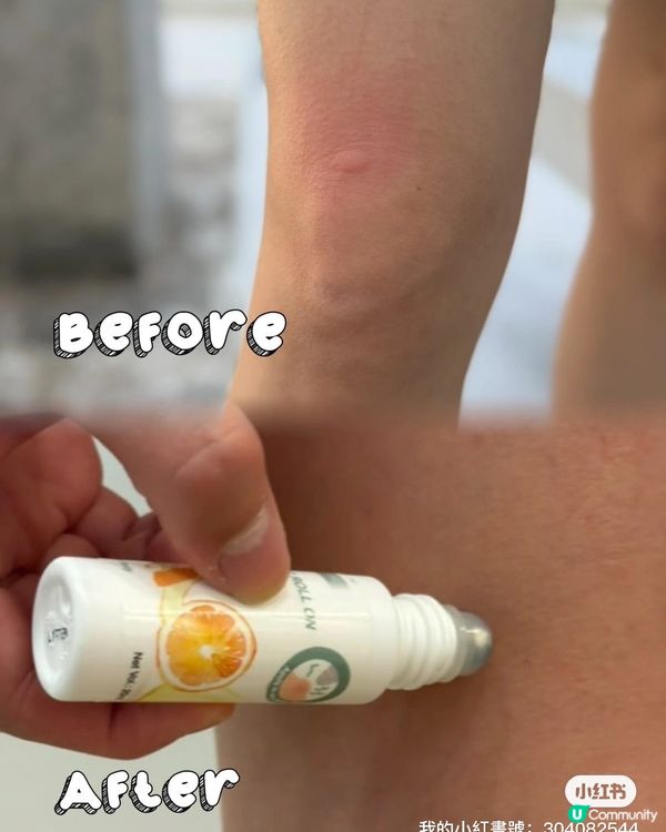夏日必備止痕神器 🦟