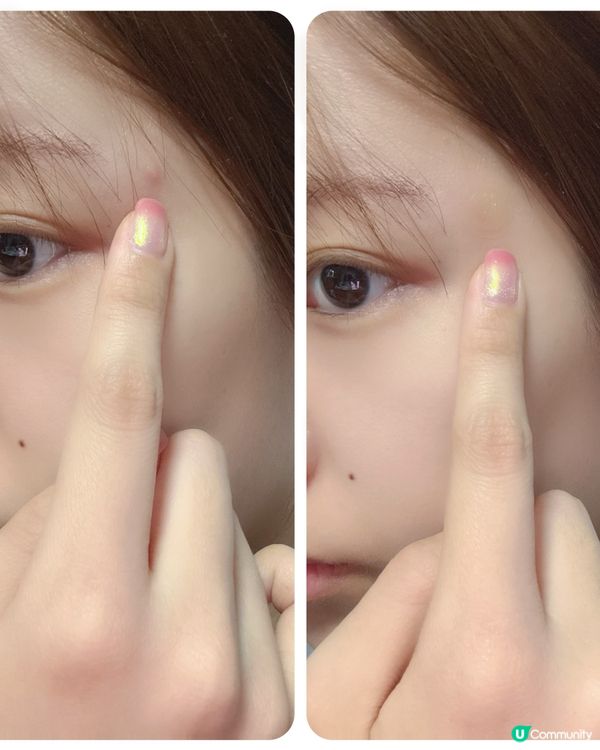 妍媽救痘痘秘技🤫痘痘貼救咗我