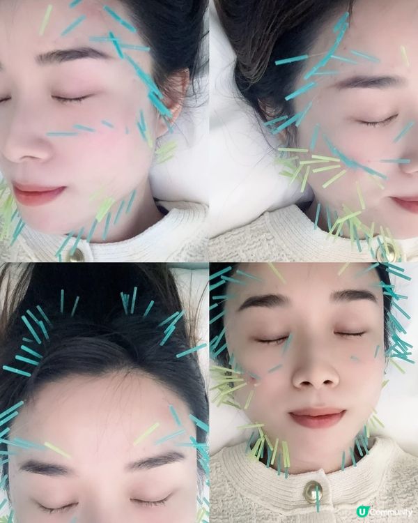 銅鑼灣德琋美顏針 ✨  陳安琪醫師幫你由內靚到外！