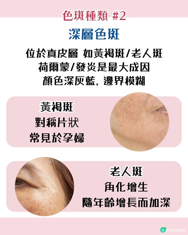 【色斑預防攻略】6個習慣令斑點不再來！6大成因☀️4類人容易長斑！