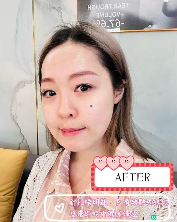 《醫美微調手記|水光針✖溶脂針の低調變美哲學》  