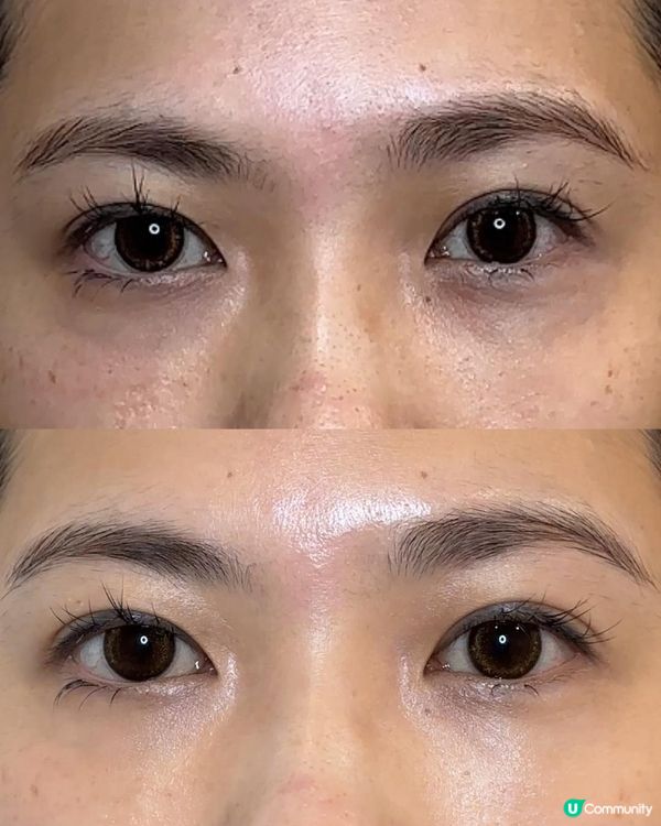 【試後感】Miracle 18眼部療程究竟有冇用？