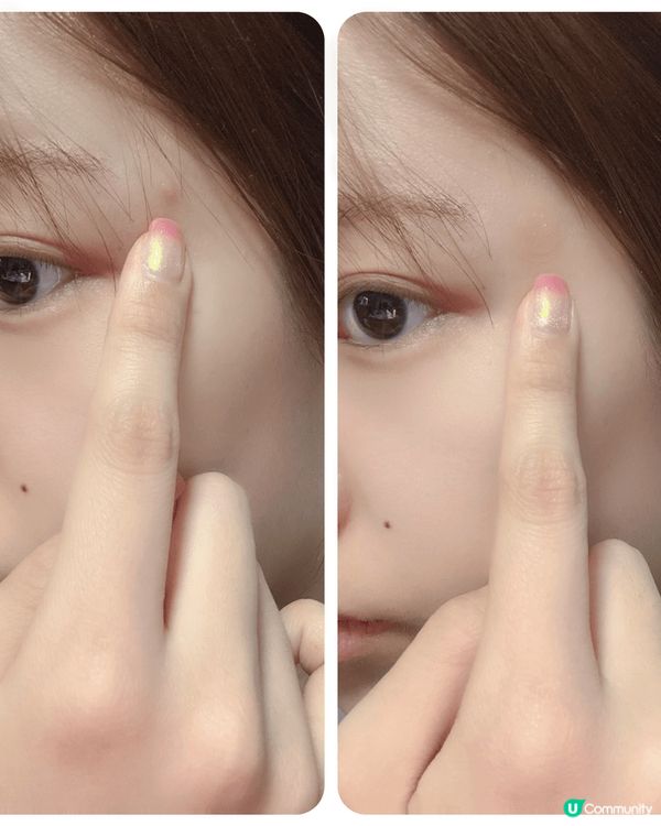 #妍媽分享🔆 DuoDERM 痘痘貼救咗我😭🔥