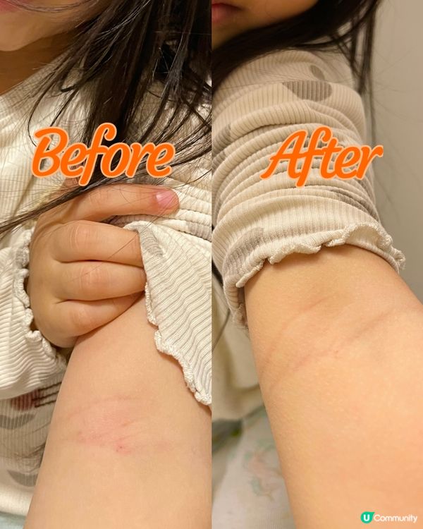 濕敏痕到瞓唔到？😩  益生菌幫你KO濕敏！💪