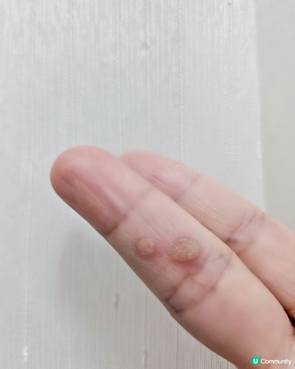 手指生疣好煩惱😭