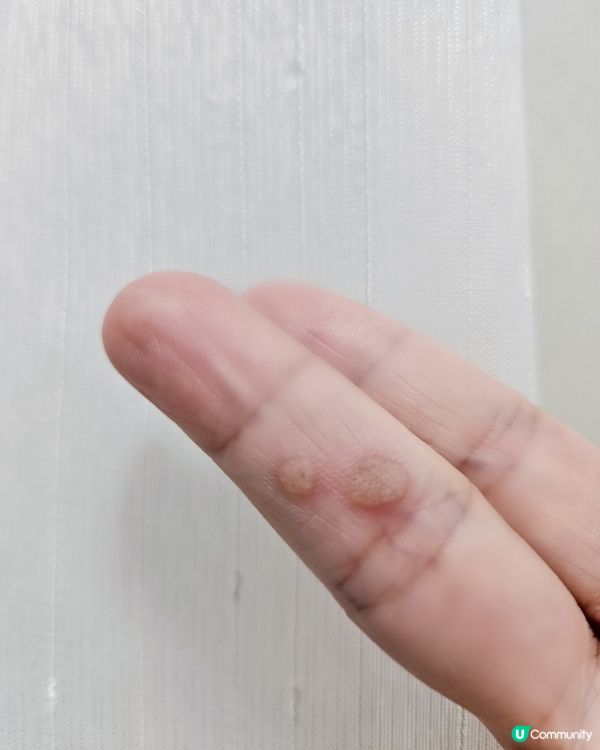 《疣》真令人煩惱‼️