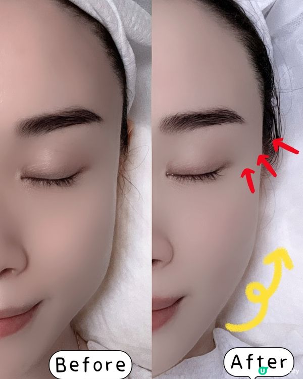 眼部肌膚緊緻❓  膠原槍幫到你💪