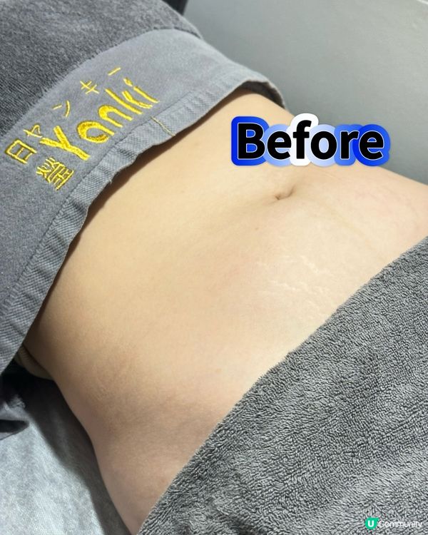 Yanki日瑩🌟 冷凍溶脂技術