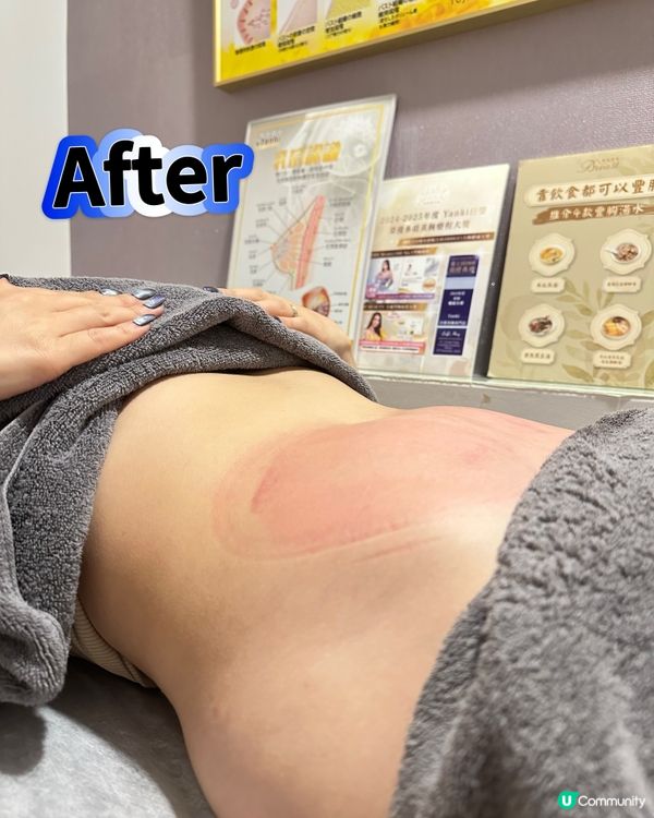 Yanki日瑩🌟 冷凍溶脂技術