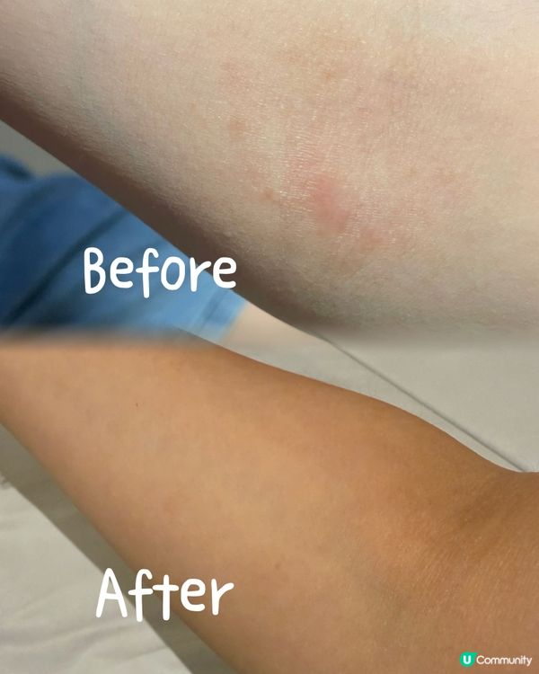 濕疹救星🌟終於可以一覺到天光啦！😴