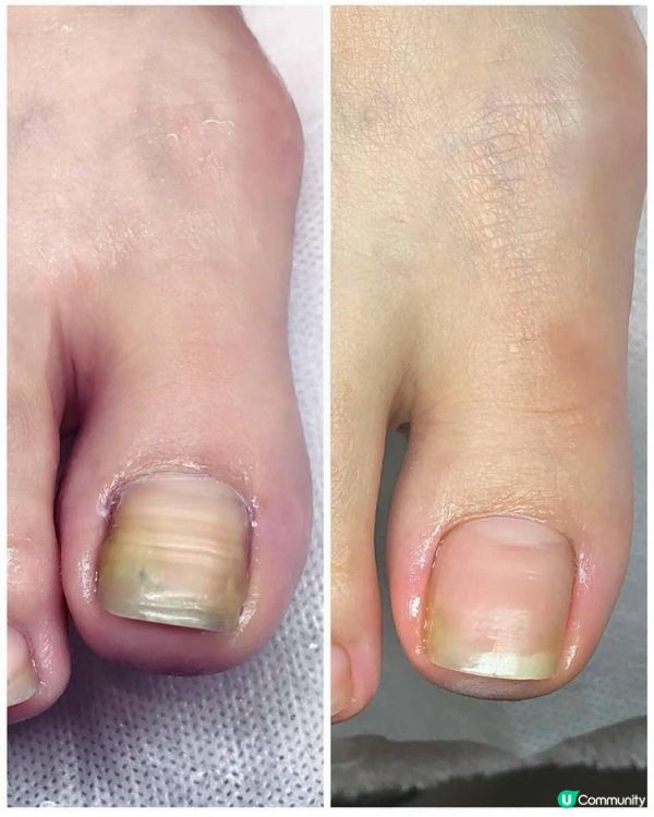 《甲再生》 真實灰甲體驗？五年灰甲患者分享自己經驗｜甲再生好唔好?