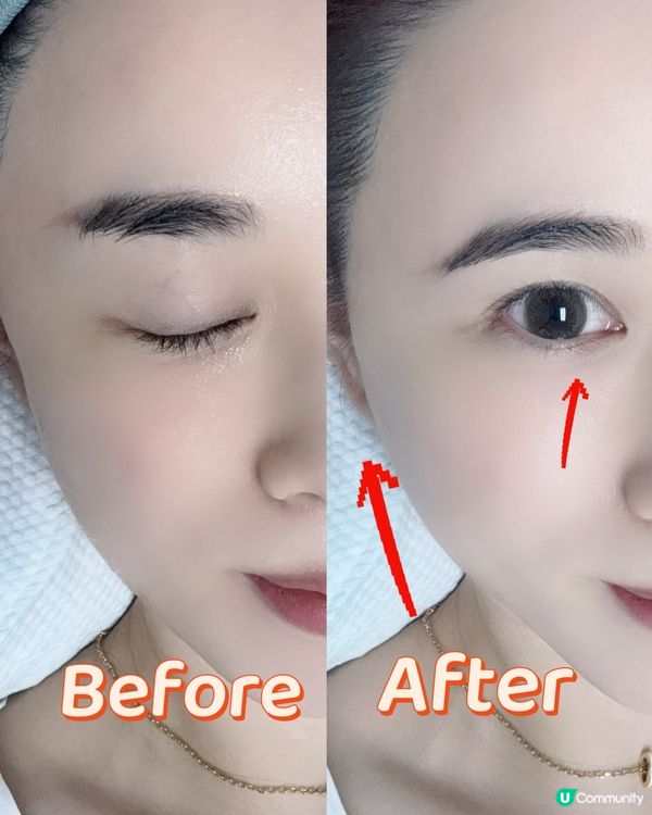 ## 二代美版超聲刀🤩  銅鑼灣體驗分享！