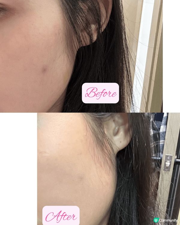 急救暗瘡，爐甘石強效祛痘消炎粉液 