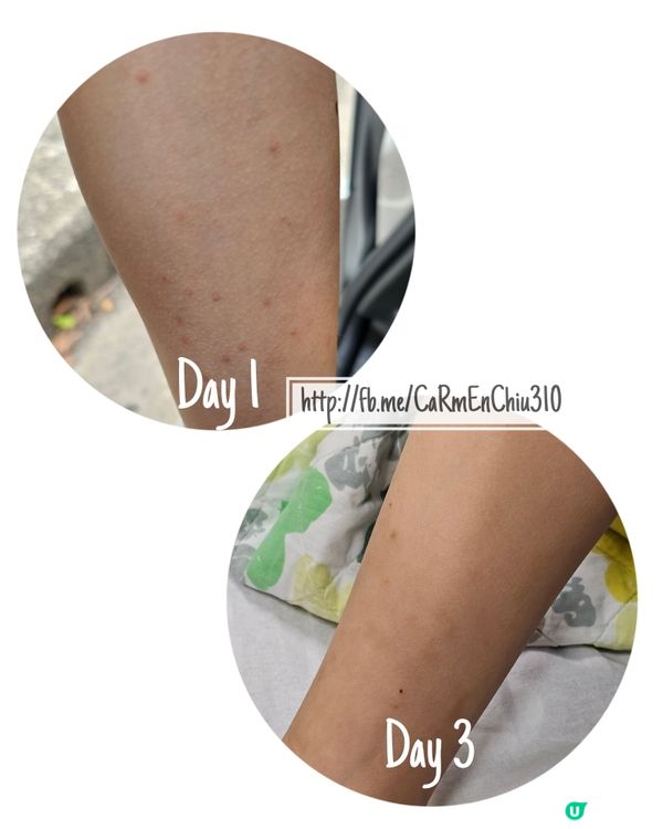 #峰迴路轉之虛驚一場 #敏感紫癜症 
